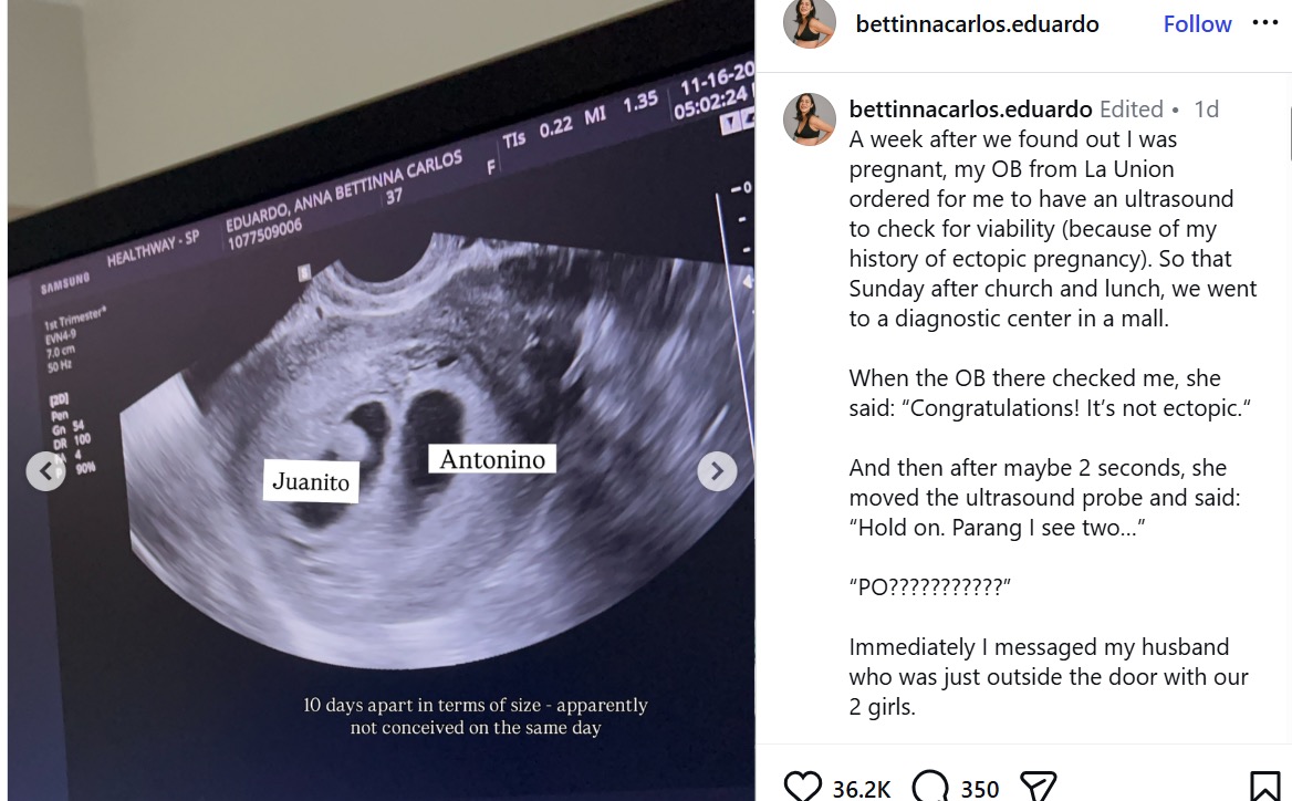Superfestation: Getting Pregnant While You Are Pregnant ‘
