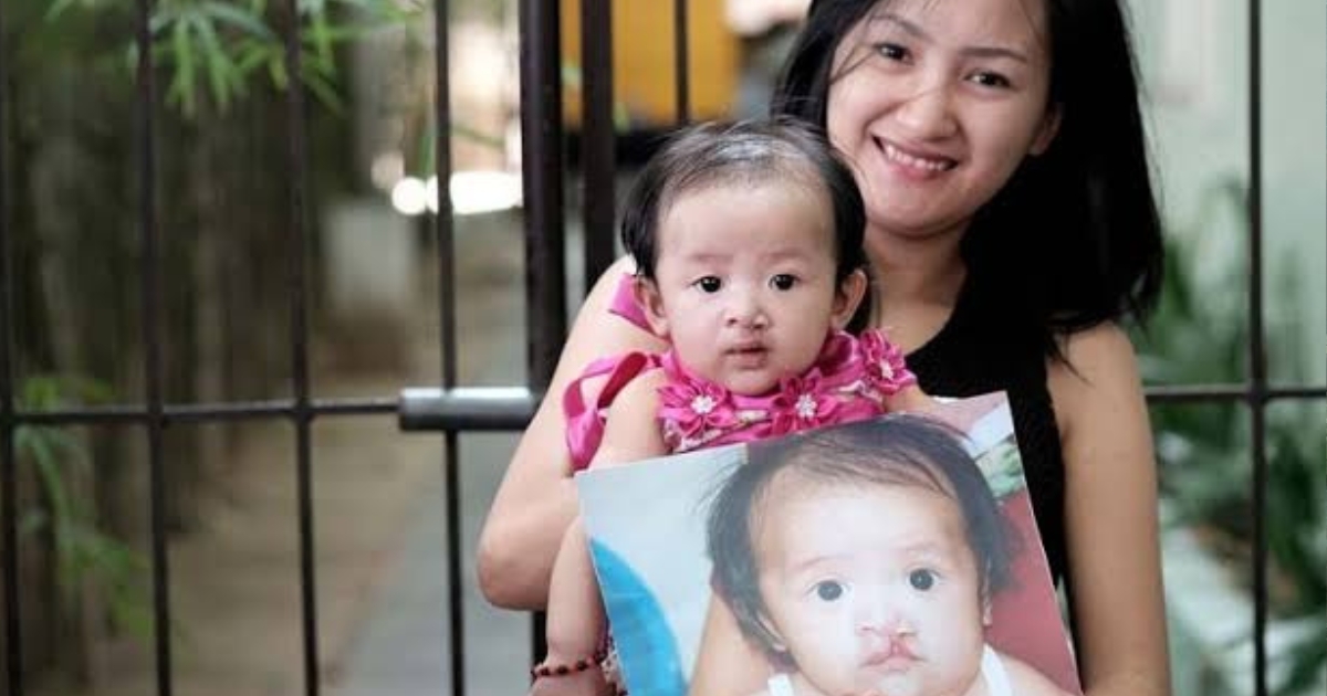 4,000 Filipino children born with clefts yearly, group seeks wider care